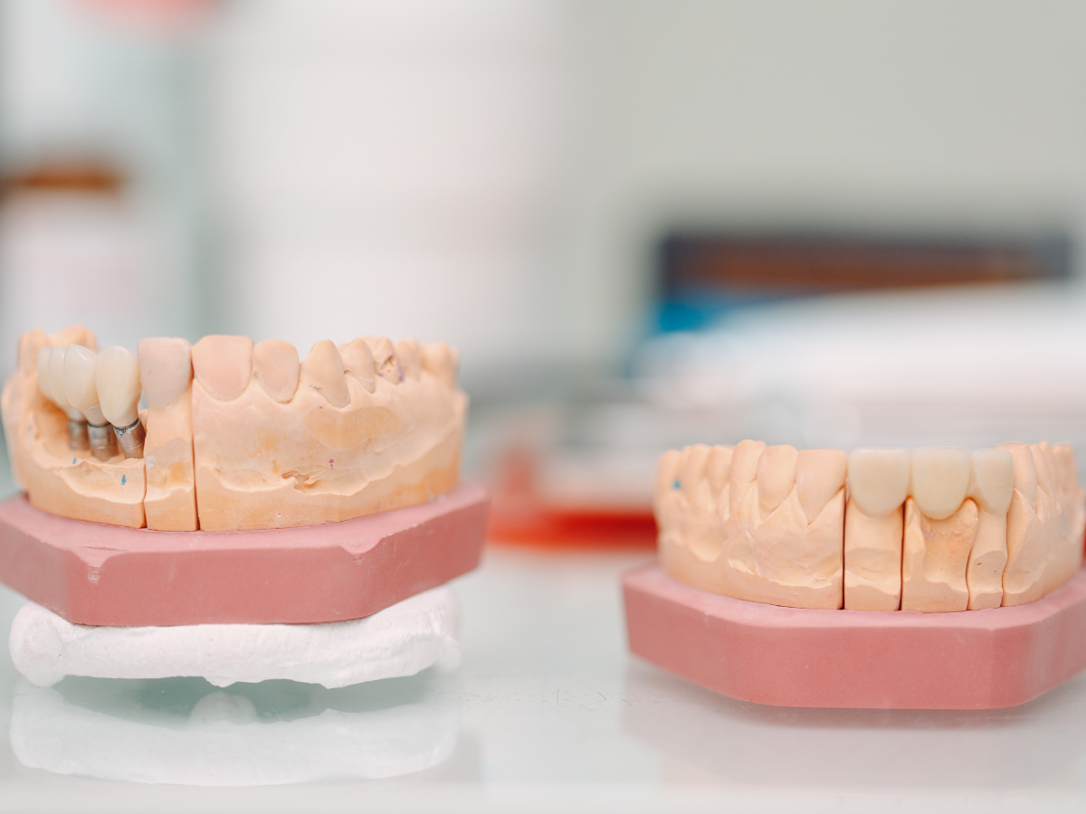 Crown and Bridge_Implants Image